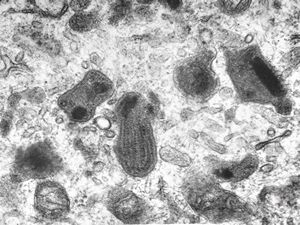 melanoblastoma - promelanosome